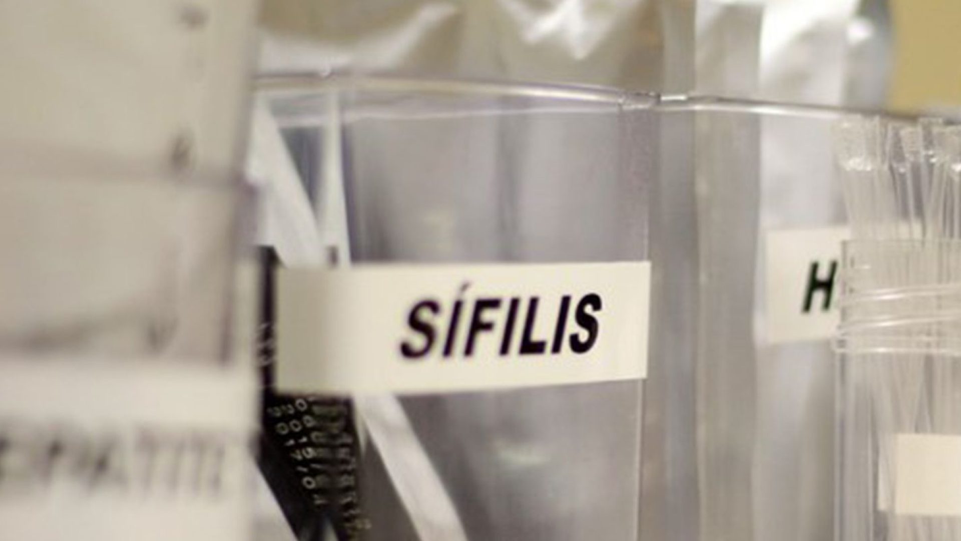 Sífilis continua em ritmo acelerado de crescimento no país