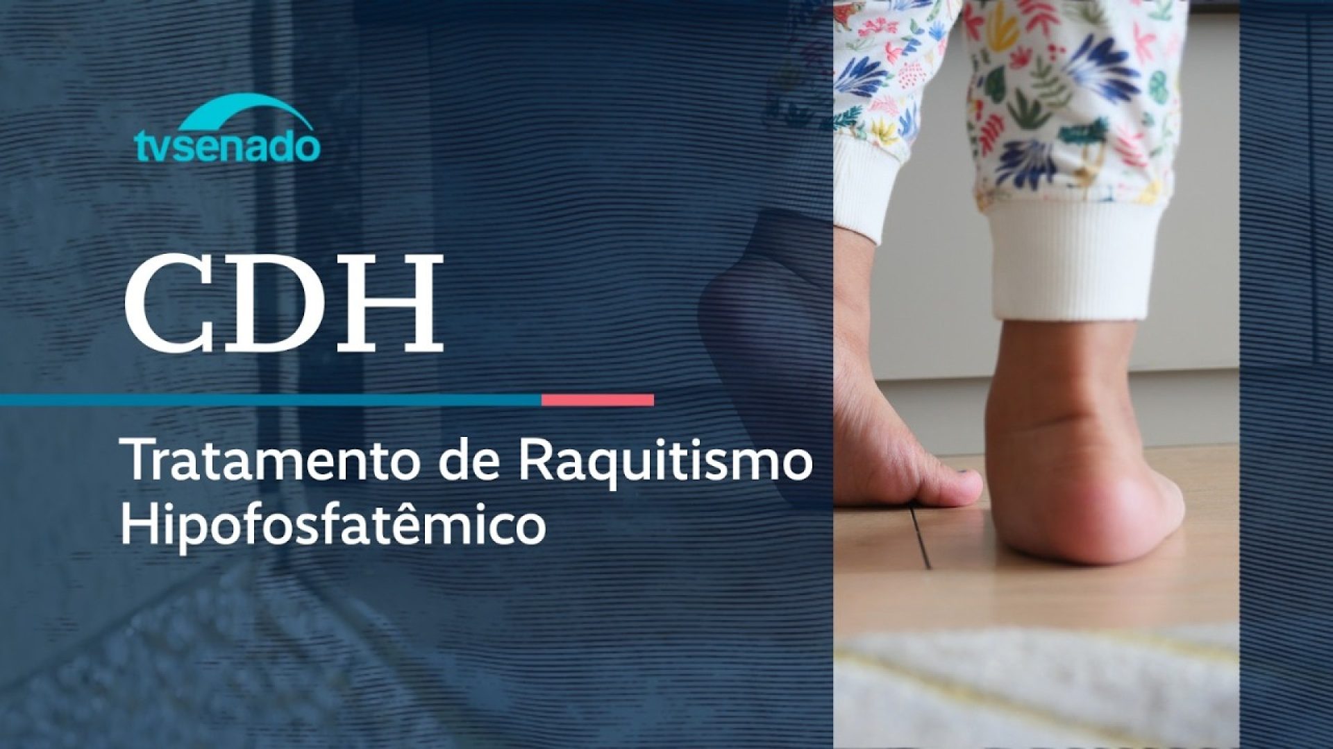 Vídeo: CDH debate tratamento do raquitismo no SUS - 23/4/26