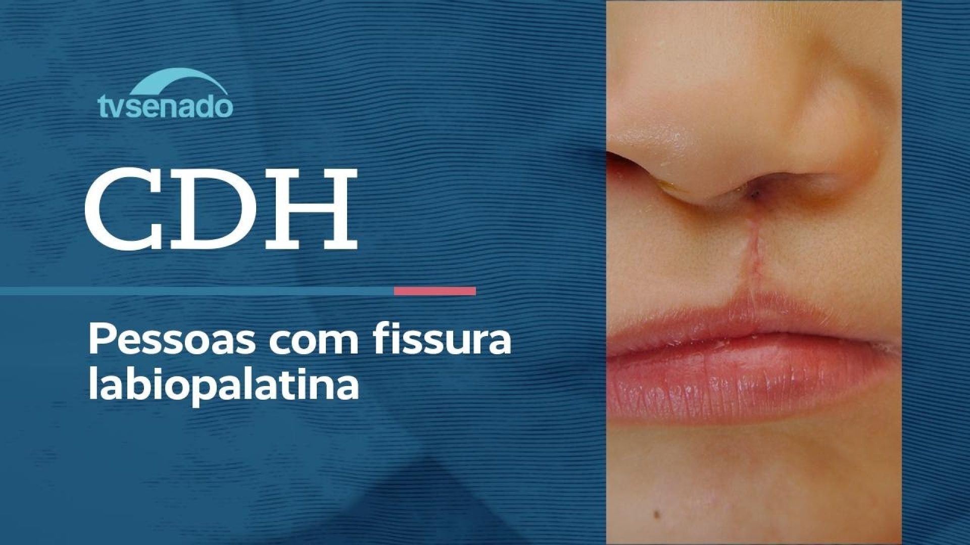 Vídeo: Ao vivo: CDH discute atenção integral para  fissura labiopalatina - 22/6/26