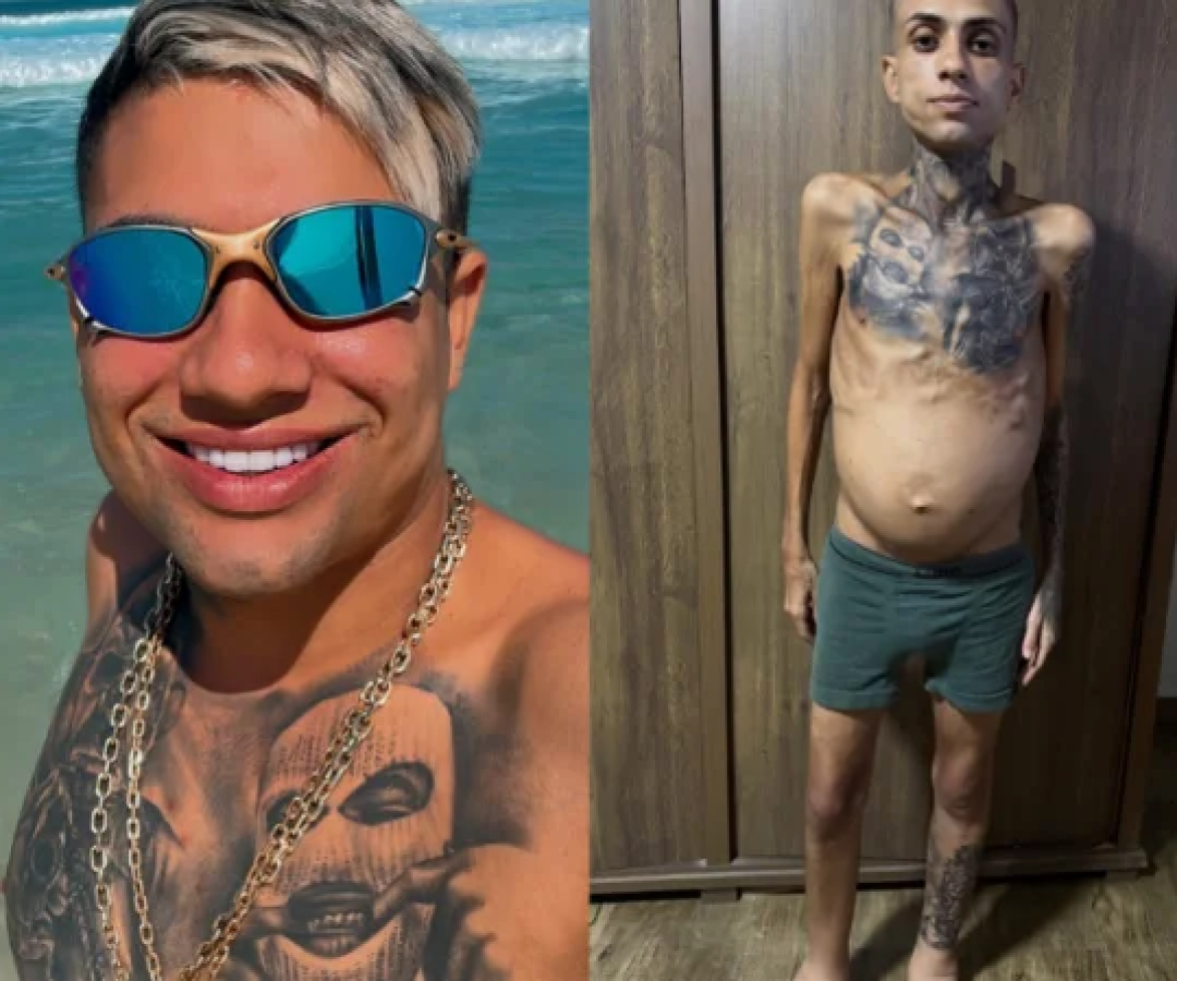 O influenciador Jota Surfista, antes e depois dos problemas de saúde -  (crédito: Reprodução/ Instagram / @jota_surfista)