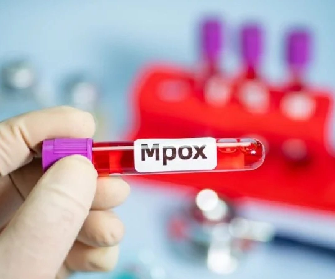 O caso de mpox foi o segundo do clado 1b no Estado -  (crédito: EdiCase)