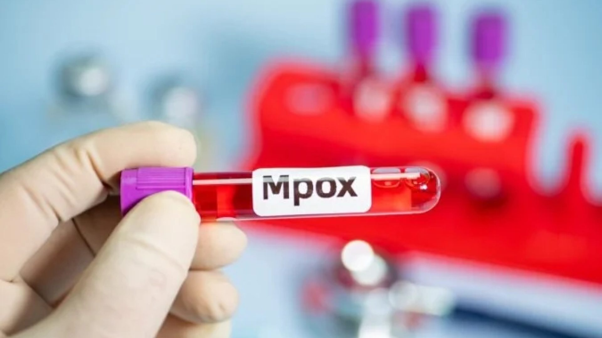 O caso de mpox foi o segundo do clado 1b no Estado -  (crédito: EdiCase)