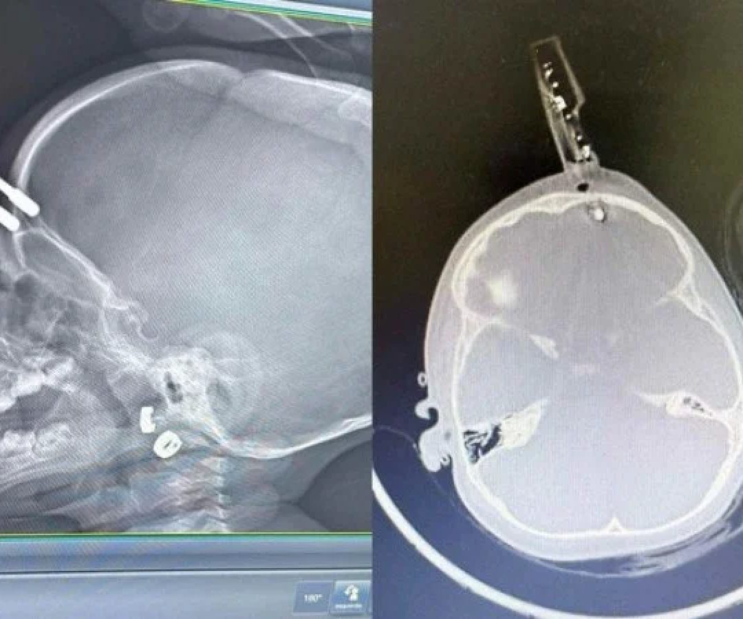 Carregador fica preso no cr&acirc;nio de beb&ecirc;  -  (crédito: Cedido ao Correio)