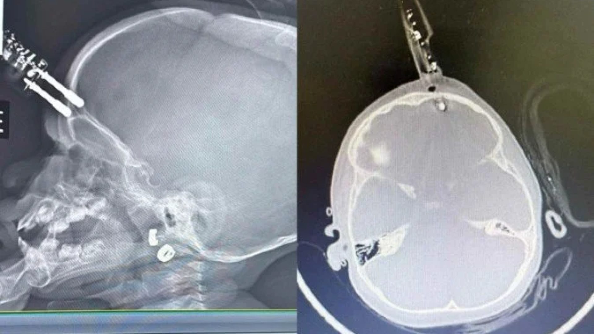 Carregador fica preso no cr&acirc;nio de beb&ecirc;  -  (crédito: Cedido ao Correio)