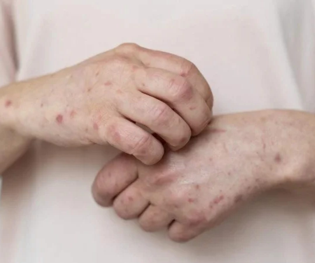 Transmitida pelo contato físico, a Mpox causa febre, dores e bolhas por todo o corpo. Foram 88 casos no país em 2026 -  (crédito: Reprodução/ Freepik)