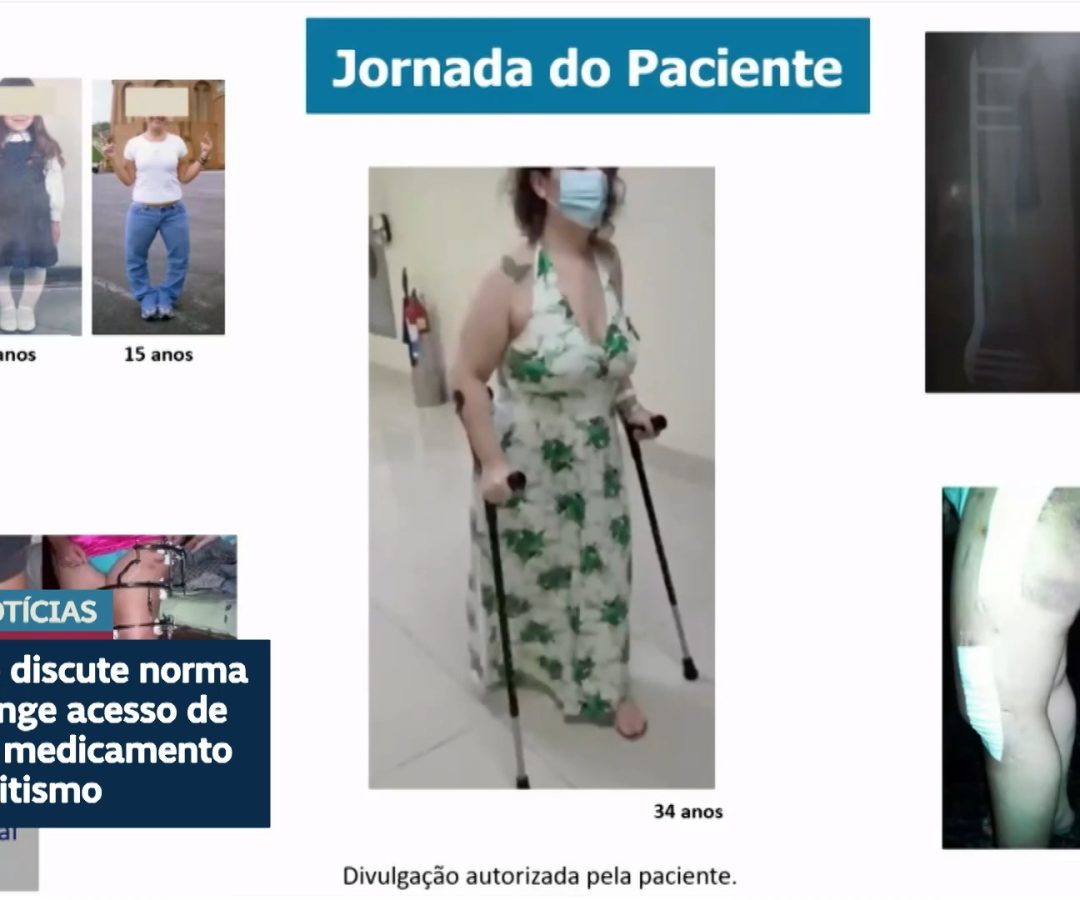Debatedores na CDH defendem ampliar uso de medicamento contra raquitismo — Senado Notícias