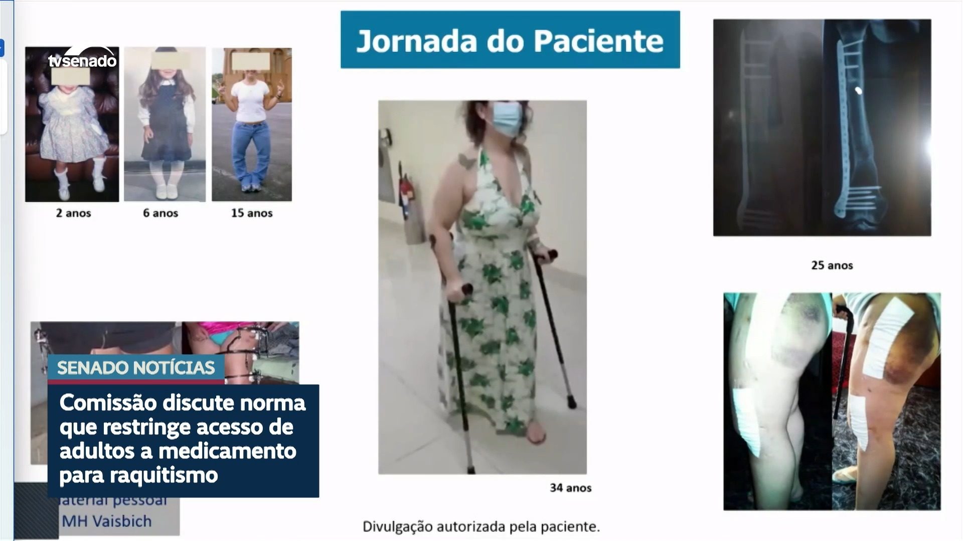 Debatedores na CDH defendem ampliar uso de medicamento contra raquitismo — Senado Notícias