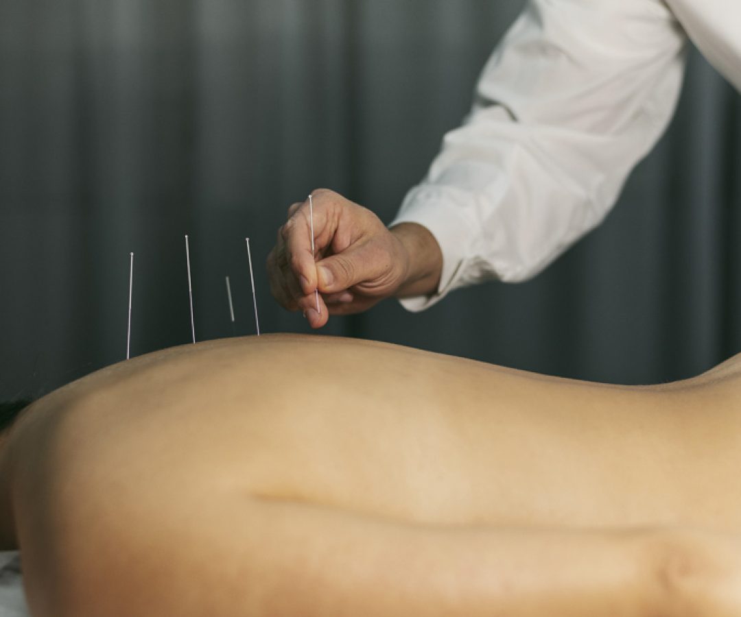 Lei regulamenta exercício profissional da acupuntura — Senado Notícias