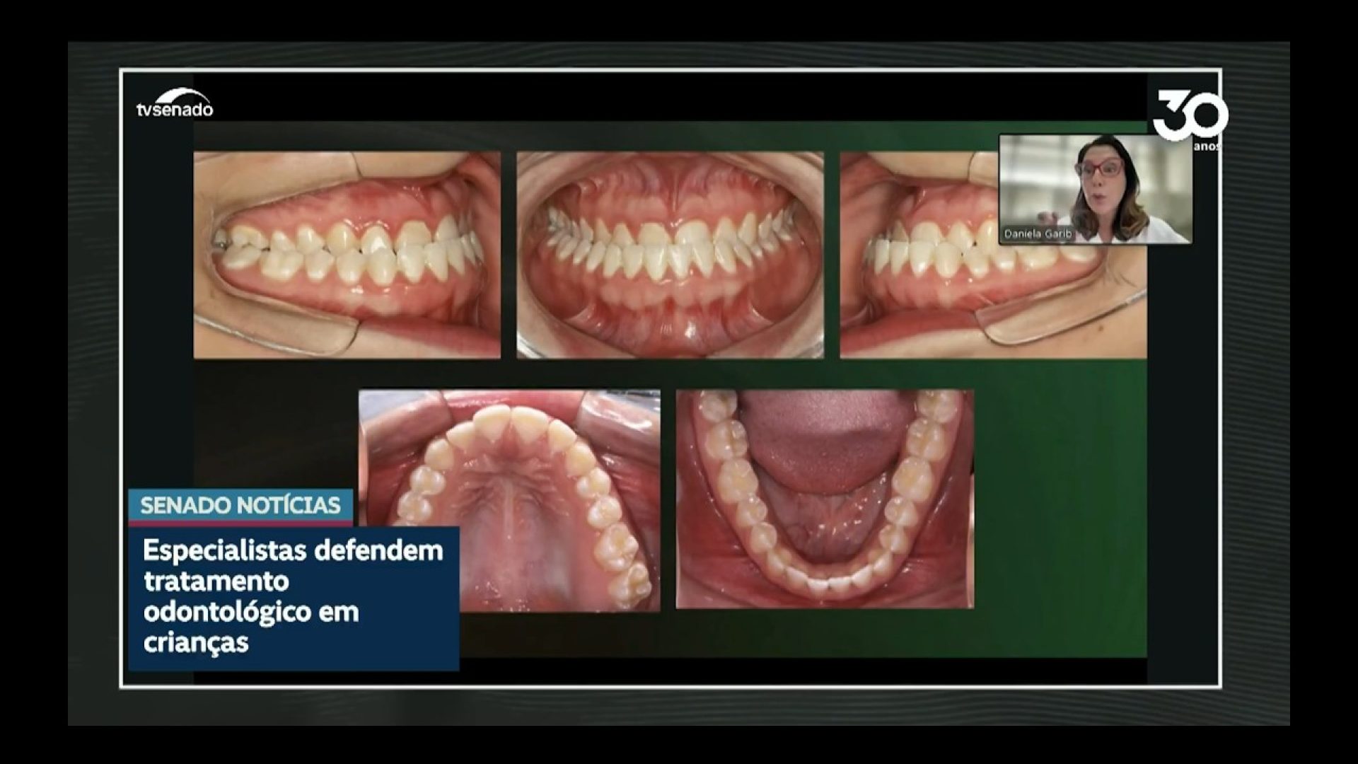 Dentistas defendem tratamento de problemas ortodônticos na infância — Senado Notícias