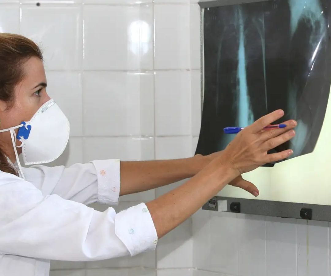 OMS recomenda testes de diagnóstico rápido para erradicar tuberculose